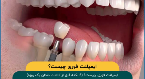 ایمپلنت-فوری-چیست؟